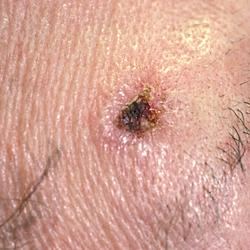 Example of skinCancer